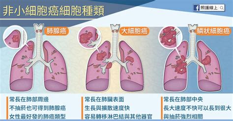 肺癌 第 四 期 能 活 多久